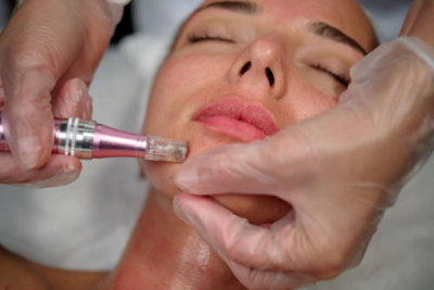 microneedling session